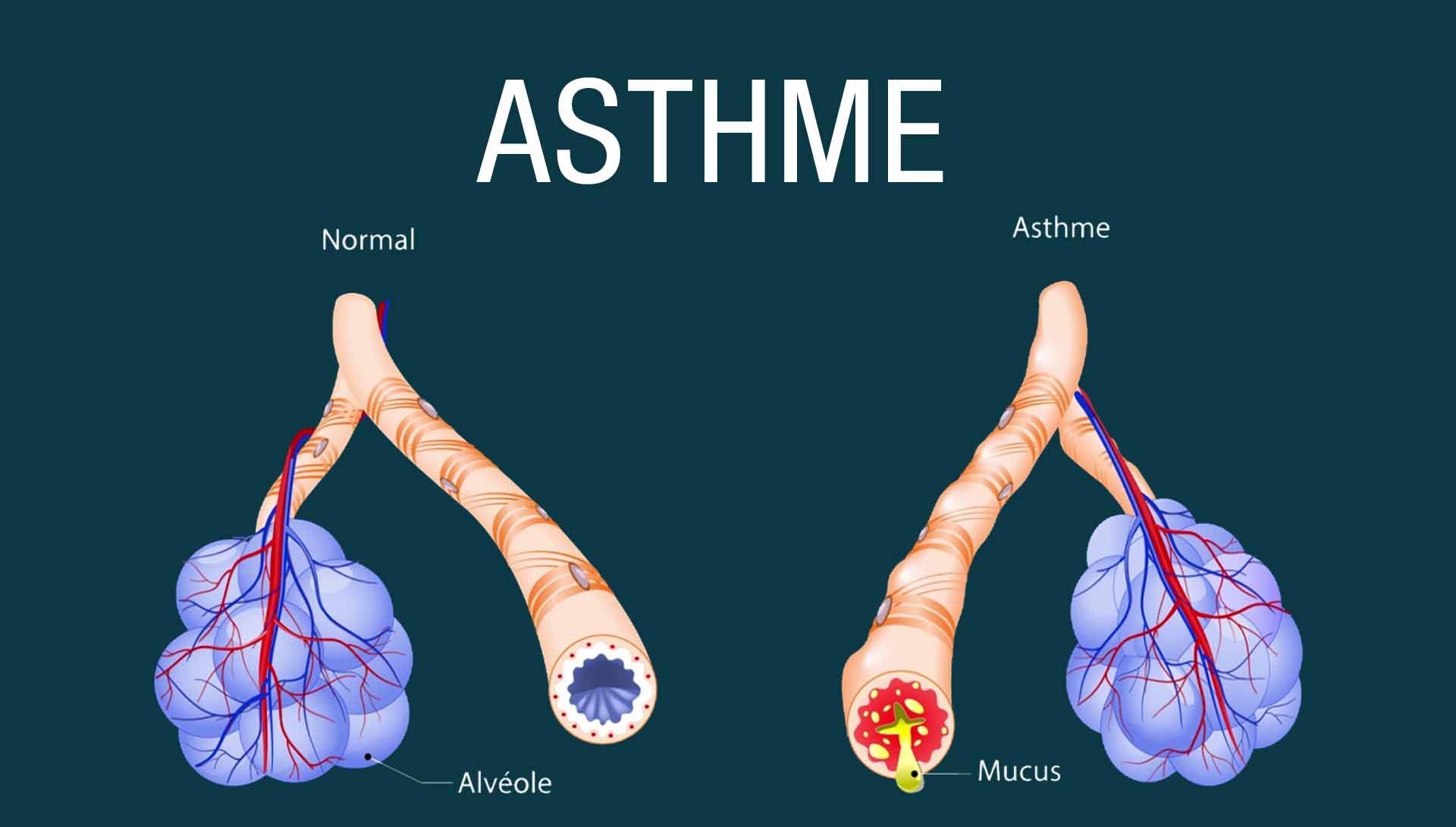 Pr Georges Ouédraogo : «L’asthme a un traitement  efficace»